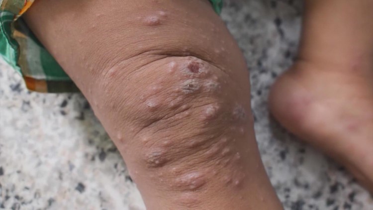 'Presumptive' pediatric case of monkeypox in Harris County ruled false positive, judge says