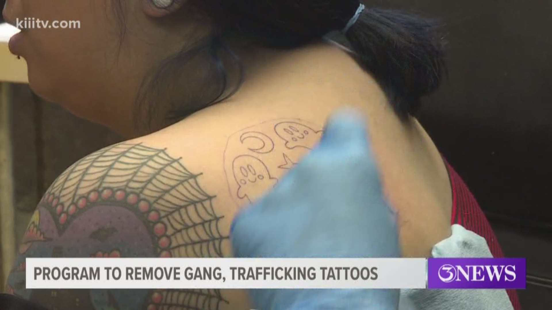 Hayward hospital removes gang prison tattoos for free  East Bay Times