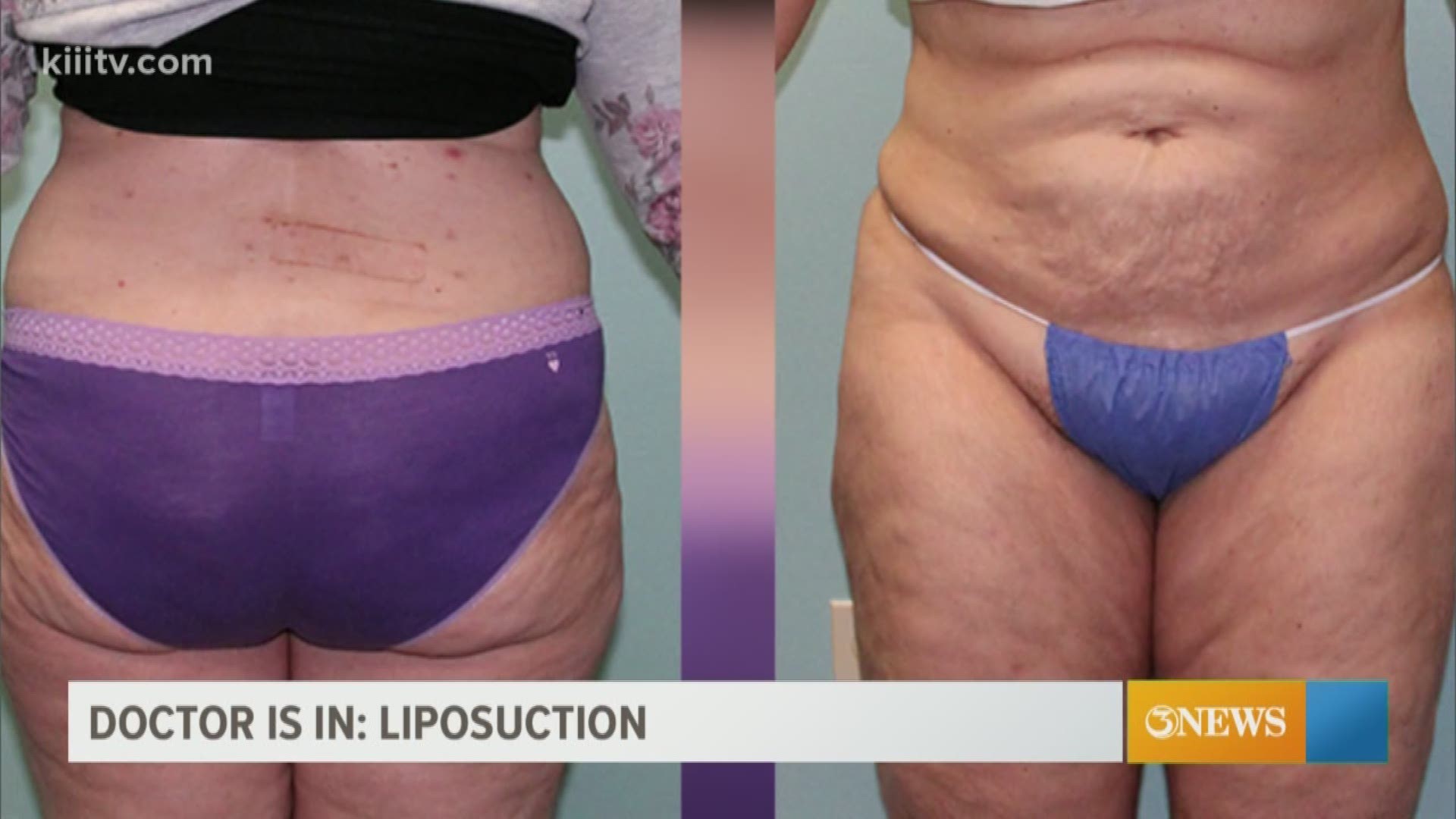 Liposuction produces impressive results but there are many factors to consider