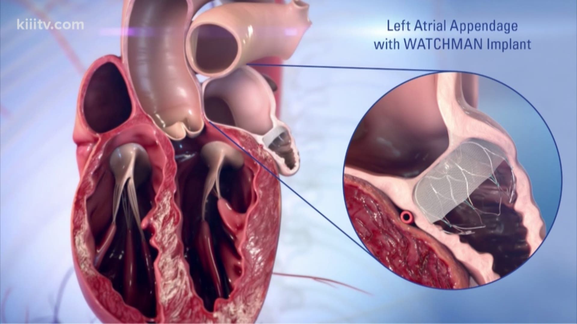 The watchman device is a left atrial appendage occlusion device that allows people in atrial fibrillation to stop anticoagulants; medicines that not everybody can tolerate.