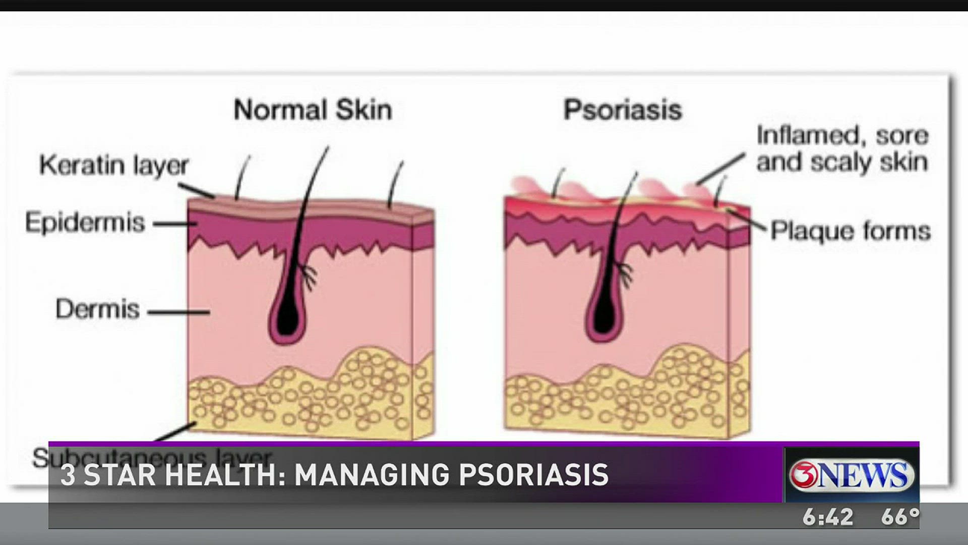 Brian Burns talks with Dr. Salim Surani about managing the skin condition psoriasis.