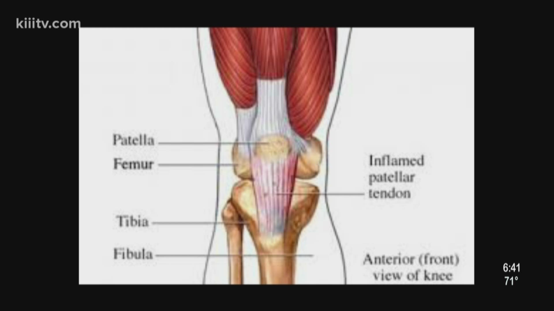 Patellar tendonitis can either lead to mild or severe pain in the knee.