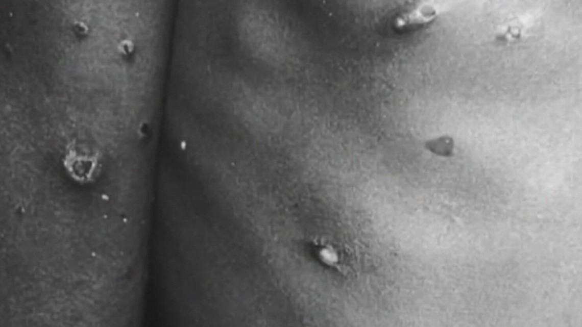 LGBTQ+ community concerned stigma will grow as monkeypox spreads - Vimarsana News