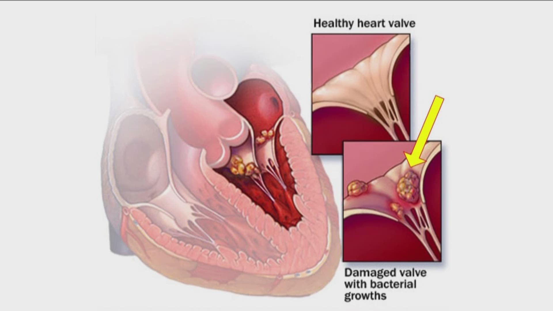 The "Dr. Is In" topic of the week is over an infection of the heart that can damage valves in the heart.