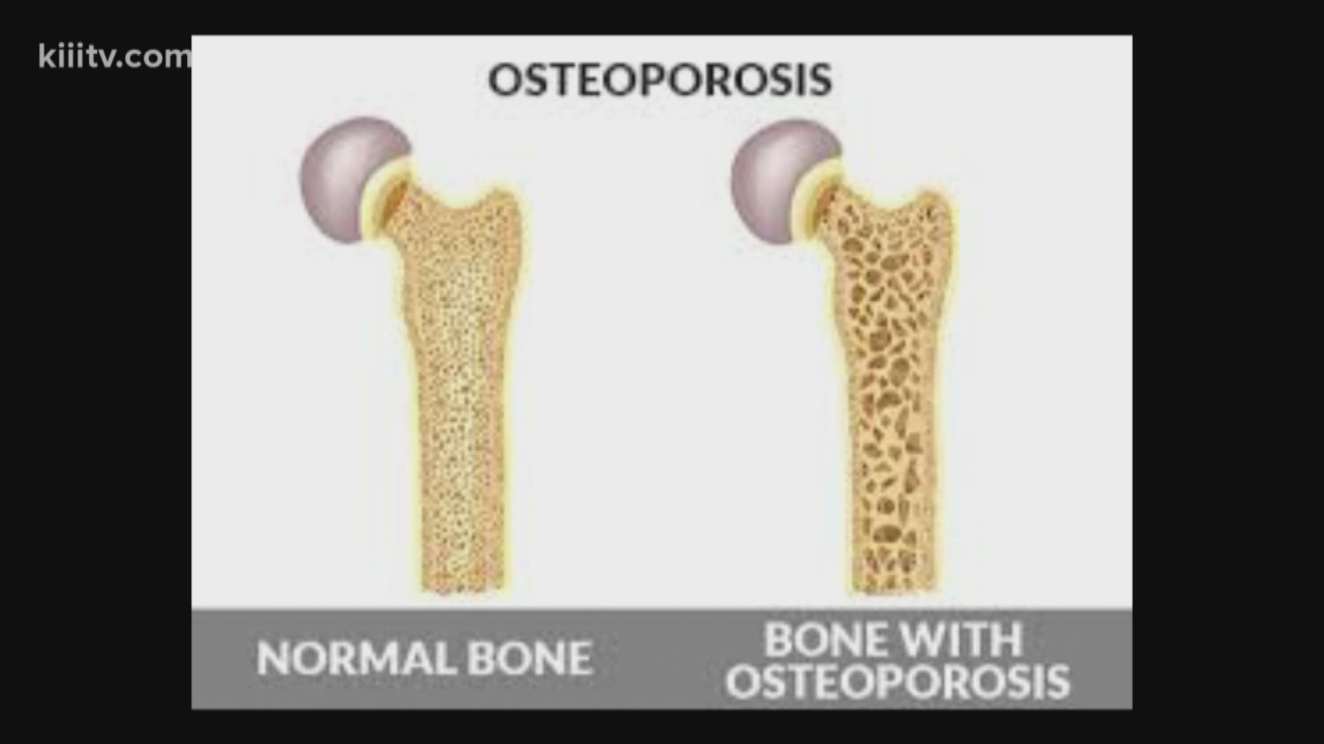 What is Osteoporosis and how it affect women more than men.