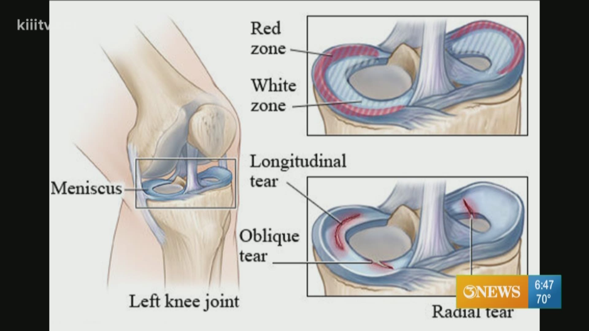 A meniscal tear is a common injury in sports.