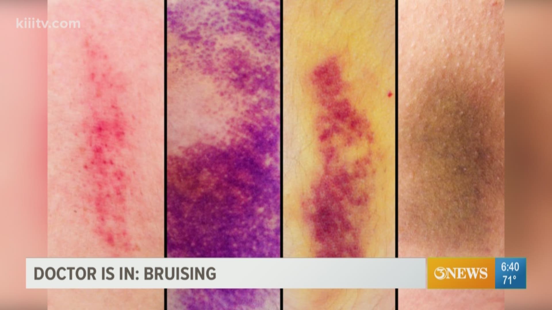 Dr. Gregg Silverman explained the various types of bruises, what they can indicate, and how to treat them.