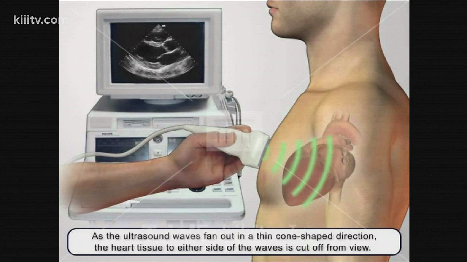 On Dr. Is In, Dr. Silverman explains why someone would need to have an ultrasound of the heart.