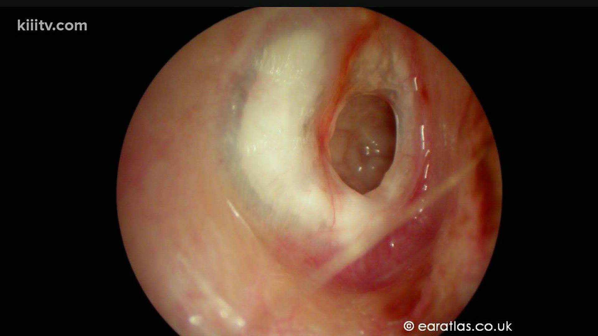 On Dr. Is In, we discuss what an ruptured eardrum is, how it can happen and what to do if you have one.
