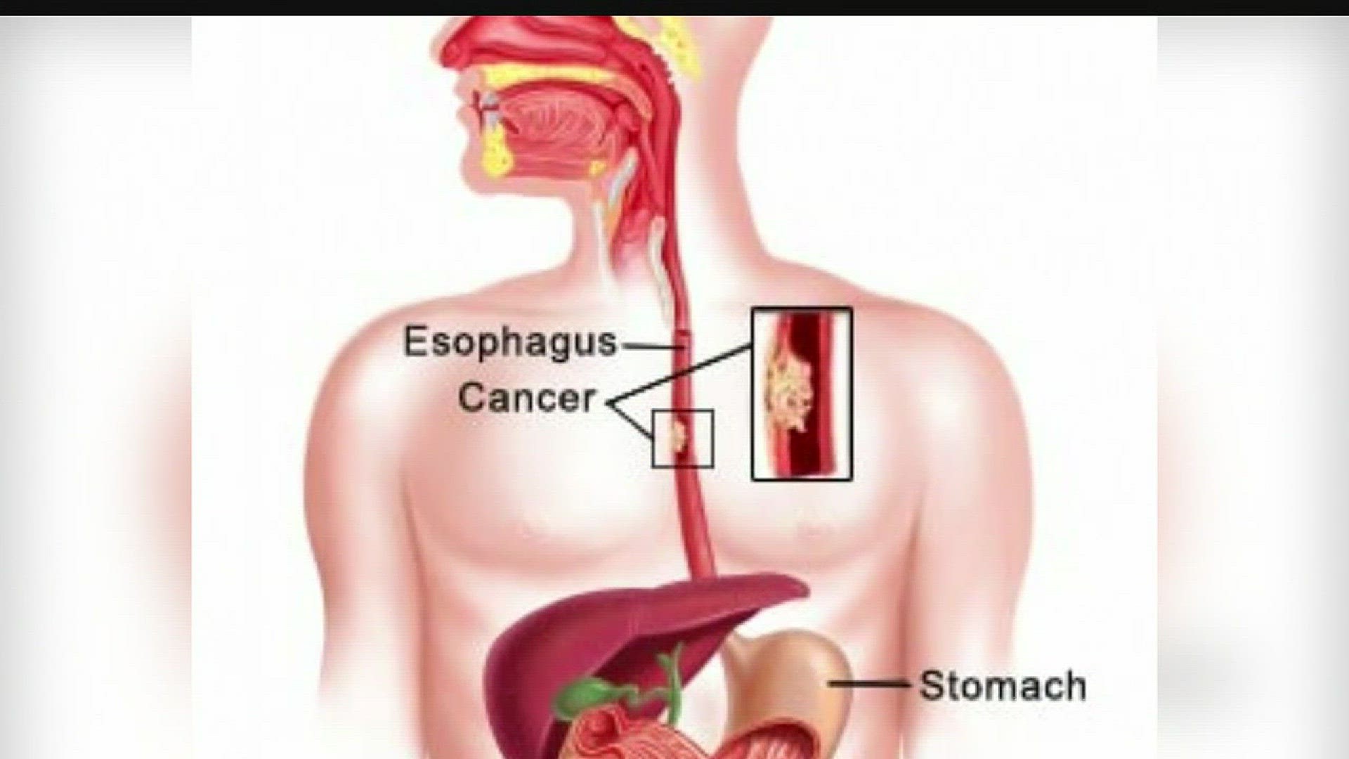 Dr. Gregg Silverman discusses affects of esophageal cancer; warning signs and treatment.