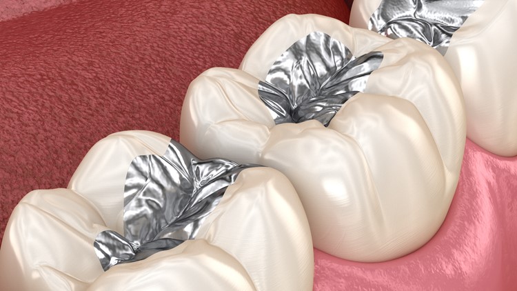 Dental fillings that contain mercury are generally safe for most adults and children