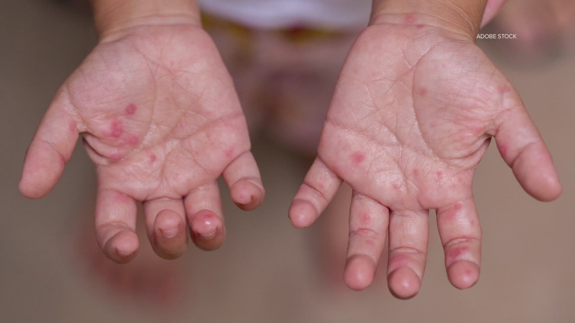 Measles case confirmed in South Texas adult, officials say