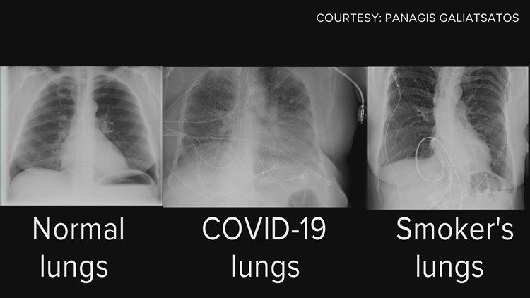 Covid lungs vs smoking lungs: Long term effects of covid on lungs ...